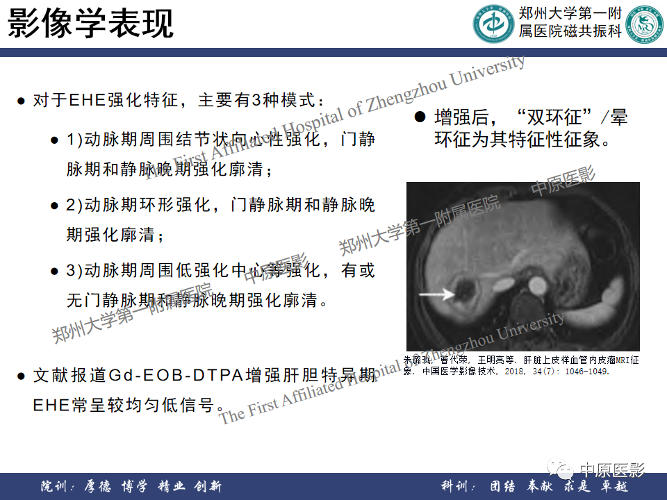影像PPT - 【病例】肝脏上皮样血管内皮瘤1例MR影像-20