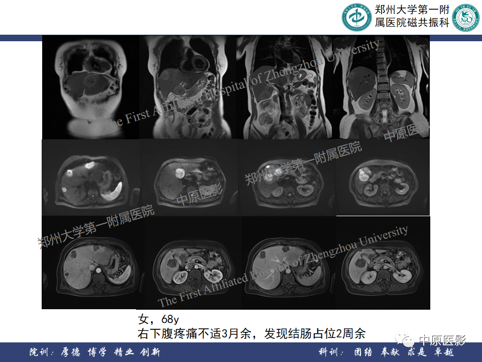 影像PPT - 【病例】肝脏上皮样血管内皮瘤1例MR影像-23