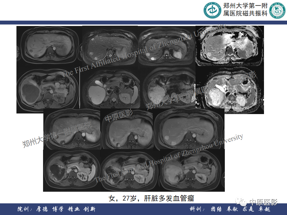 影像PPT - 【病例】肝脏上皮样血管内皮瘤1例MR影像-25
