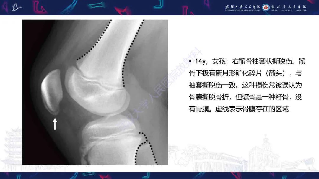 影像PPT - 【PPT】骨膜病变影像诊断-6