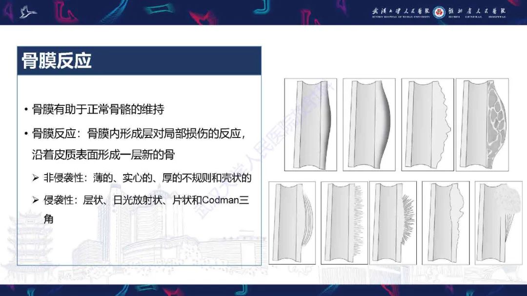 影像PPT - 【PPT】骨膜病变影像诊断-7