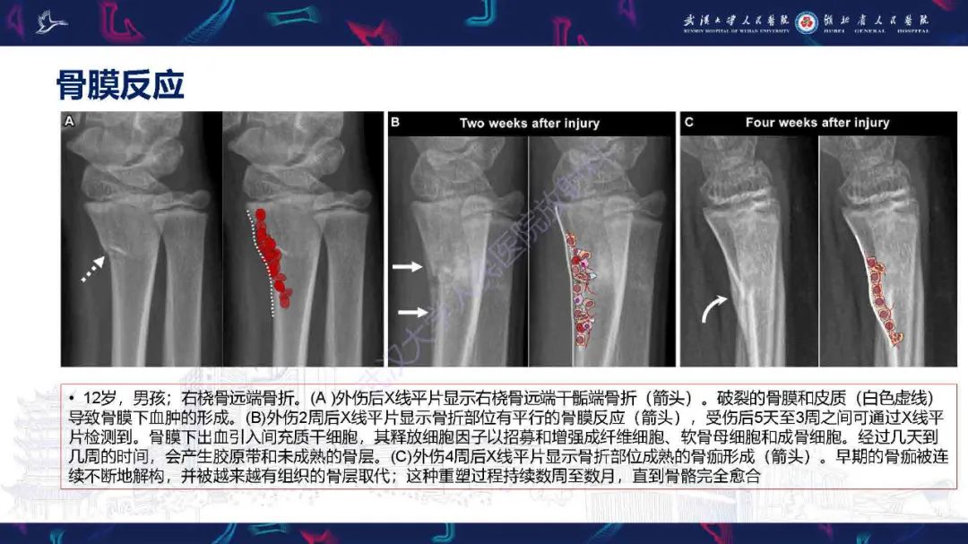 影像PPT - 【PPT】骨膜病变影像诊断-8
