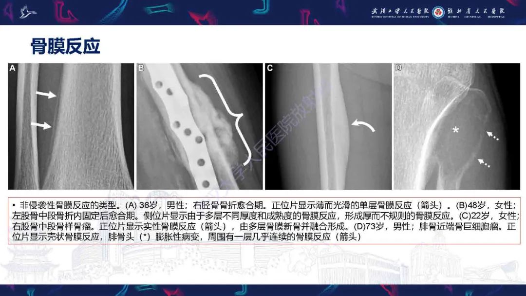 影像PPT - 【PPT】骨膜病变影像诊断-9