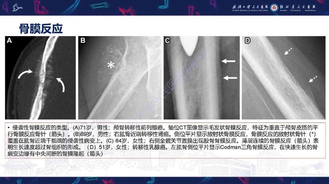 影像PPT - 【PPT】骨膜病变影像诊断-10