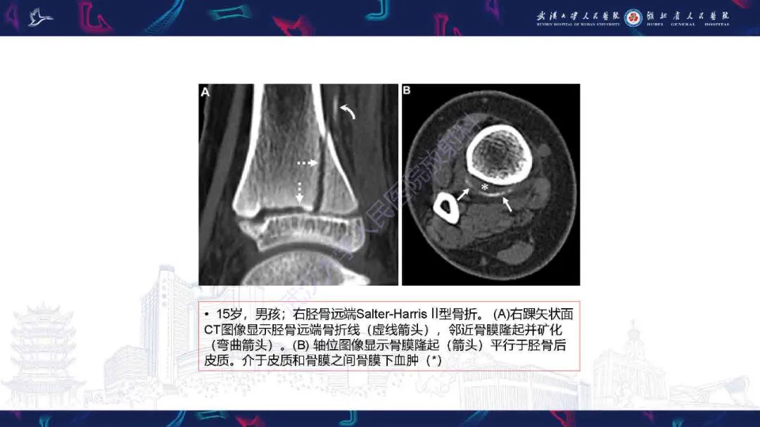影像PPT - 【PPT】骨膜病变影像诊断-13