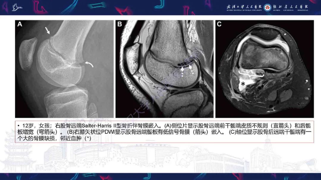 影像PPT - 【PPT】骨膜病变影像诊断-14