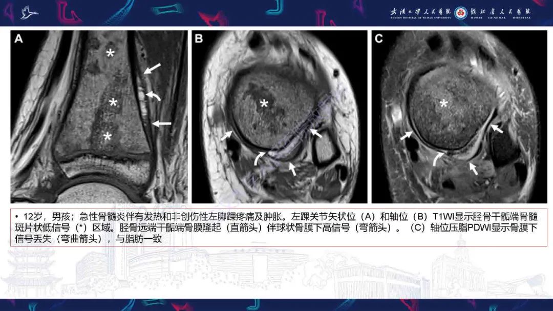 影像PPT - 【PPT】骨膜病变影像诊断-16