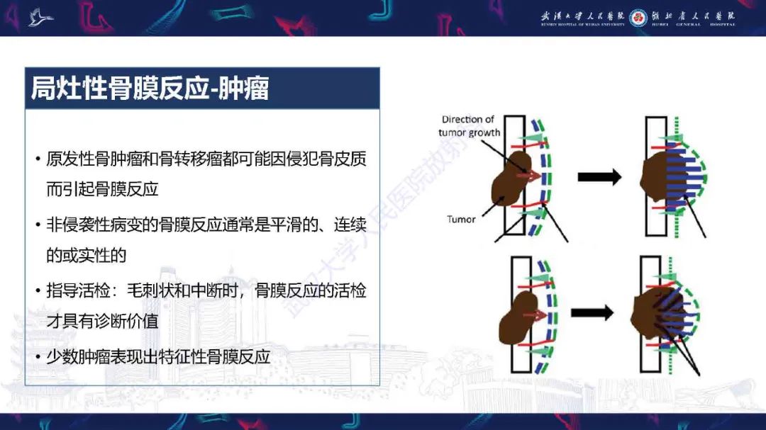 影像PPT - 【PPT】骨膜病变影像诊断-17