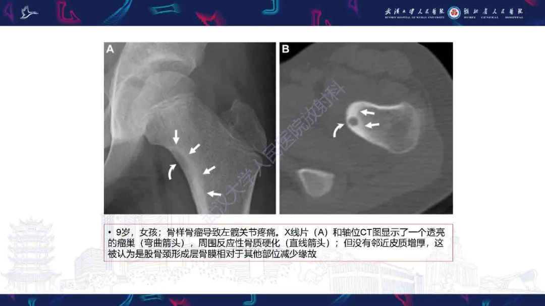 影像PPT - 【PPT】骨膜病变影像诊断-19