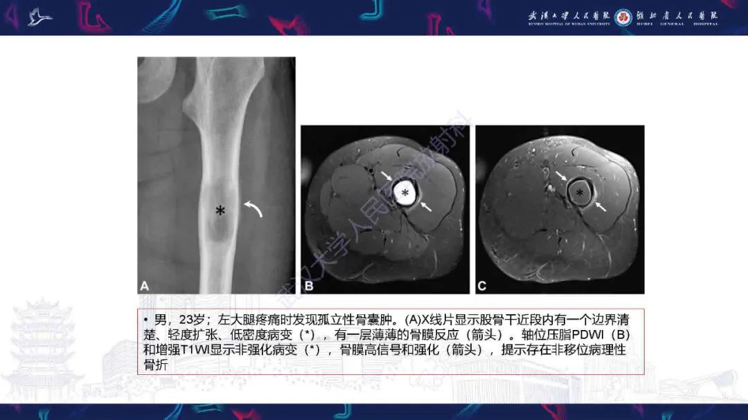 影像PPT - 【PPT】骨膜病变影像诊断-18