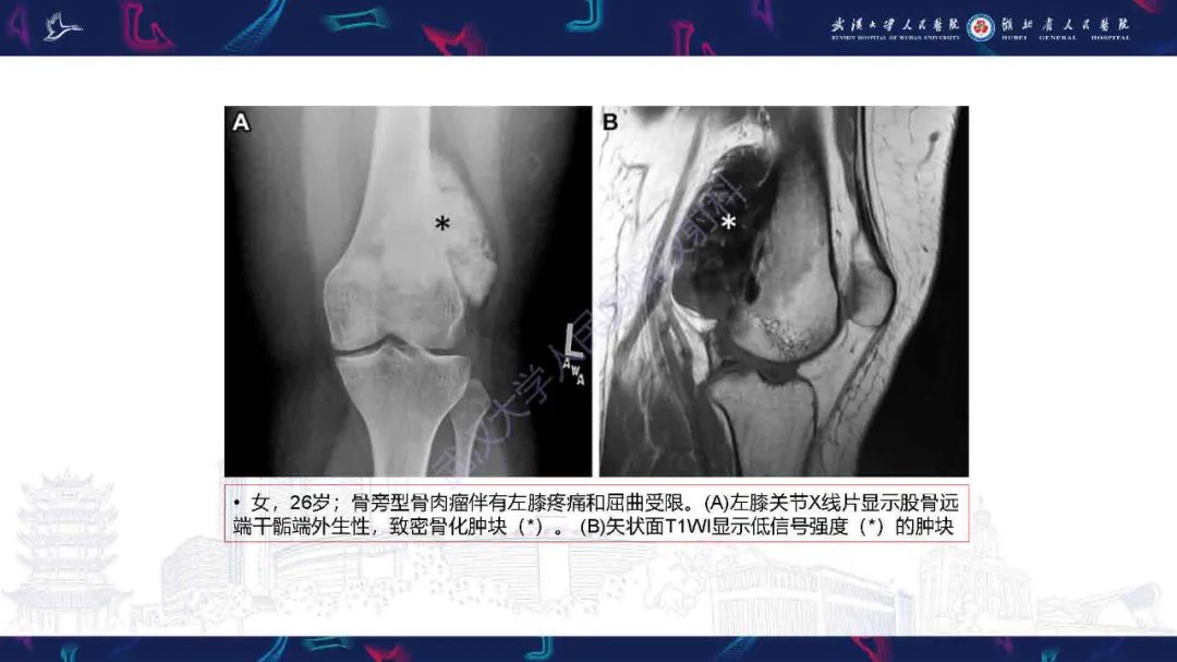 影像PPT - 【PPT】骨膜病变影像诊断-20