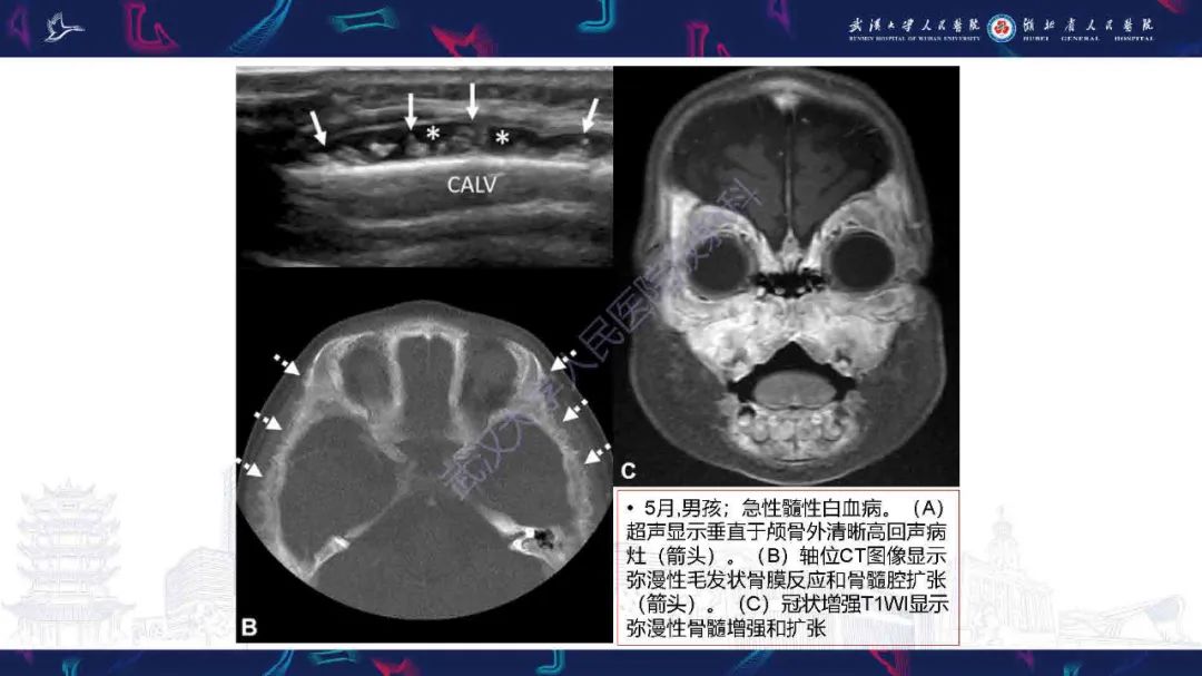 影像PPT - 【PPT】骨膜病变影像诊断-22