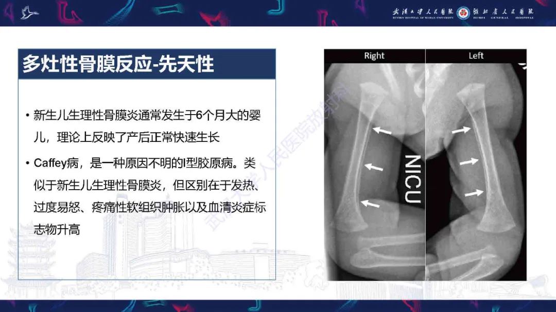 影像PPT - 【PPT】骨膜病变影像诊断-23