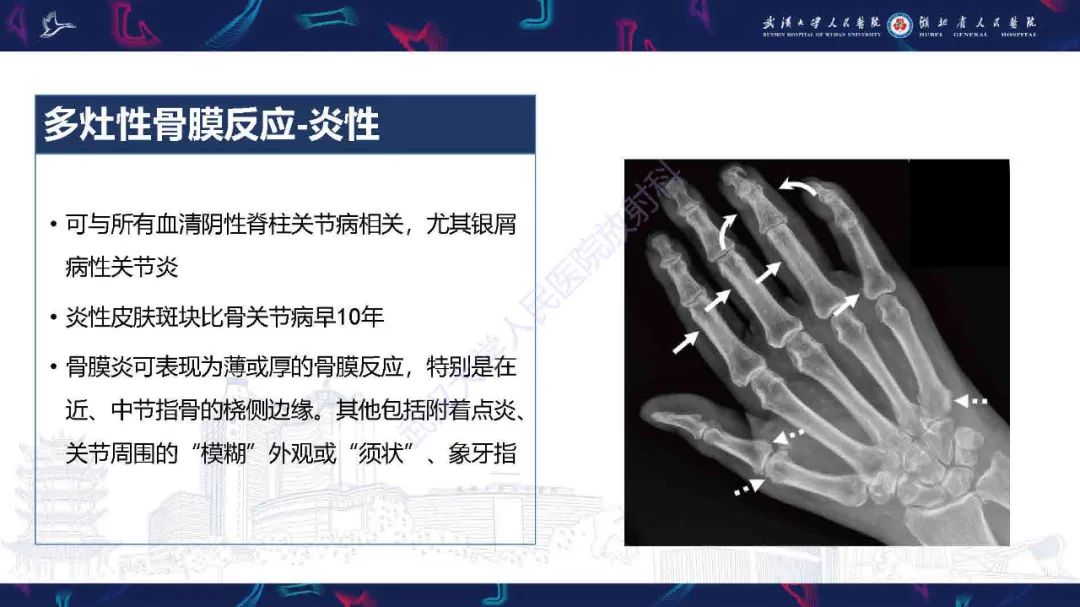 影像PPT - 【PPT】骨膜病变影像诊断-24