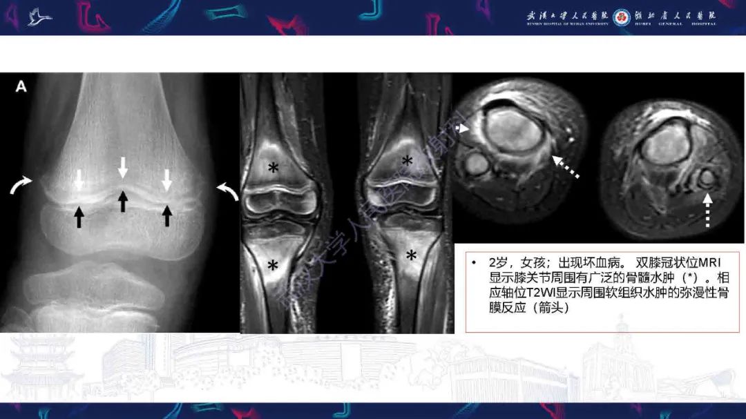 影像PPT - 【PPT】骨膜病变影像诊断-26