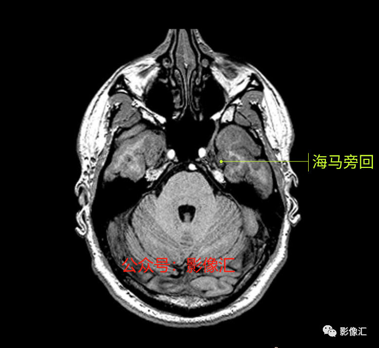影像PPT - 脑边缘叶MR解剖标记-2
