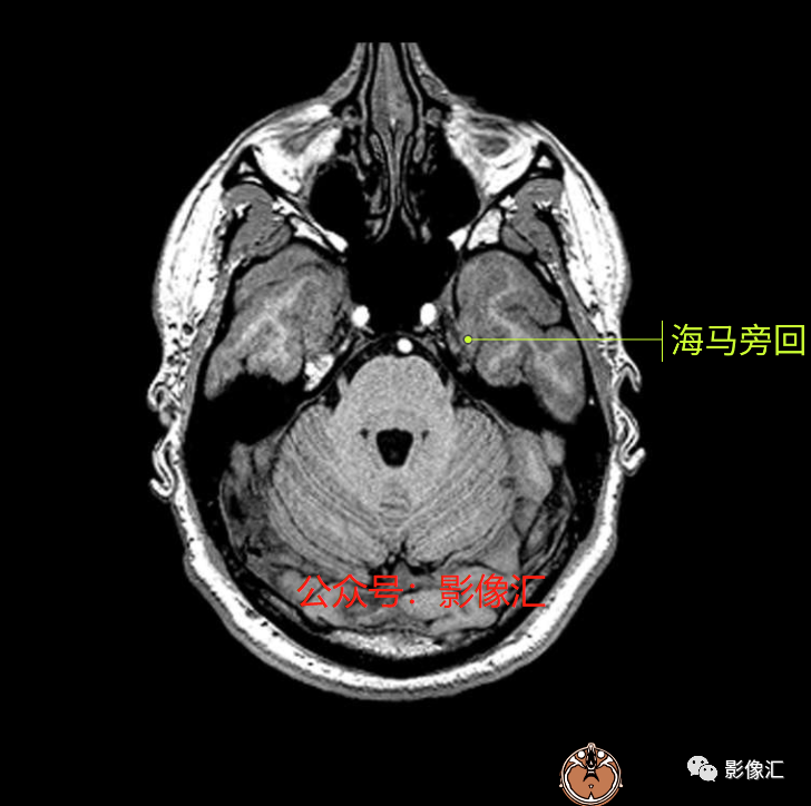 影像PPT - 脑边缘叶MR解剖标记-3