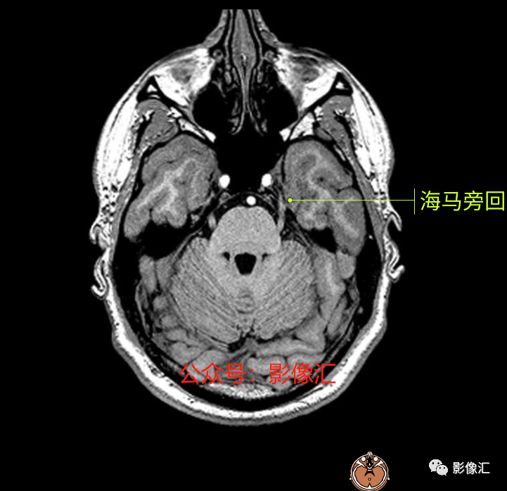 影像PPT - 脑边缘叶MR解剖标记-4