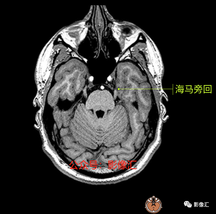 影像PPT - 脑边缘叶MR解剖标记-5