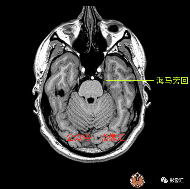 影像PPT - 脑边缘叶MR解剖标记-6