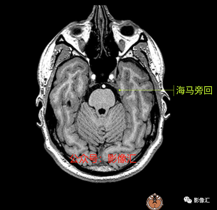 影像PPT - 脑边缘叶MR解剖标记-7