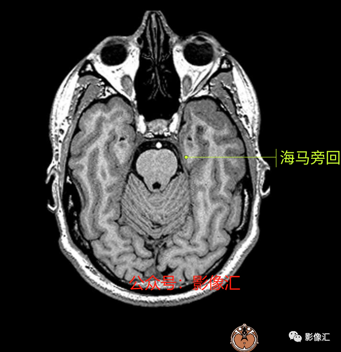 影像PPT - 脑边缘叶MR解剖标记-10