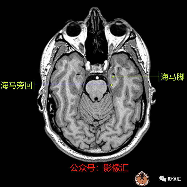 影像PPT - 脑边缘叶MR解剖标记-11