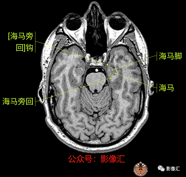 影像PPT - 脑边缘叶MR解剖标记-12