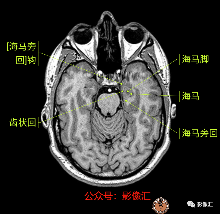 影像PPT - 脑边缘叶MR解剖标记-13