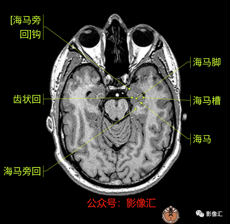 影像PPT - 脑边缘叶MR解剖标记-15