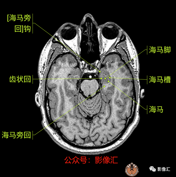 影像PPT - 脑边缘叶MR解剖标记-14