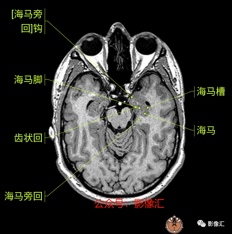 影像PPT - 脑边缘叶MR解剖标记-16