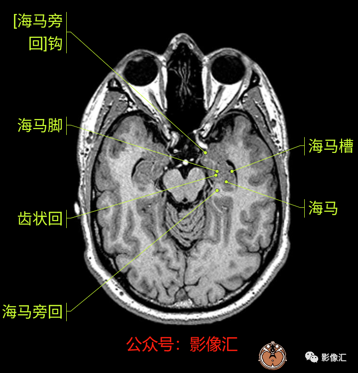 影像PPT - 脑边缘叶MR解剖标记-17