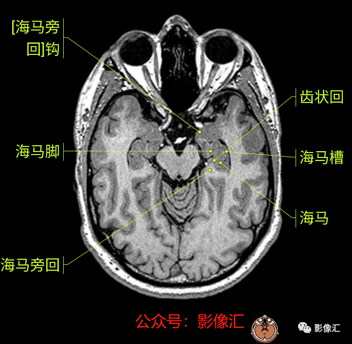 影像PPT - 脑边缘叶MR解剖标记-18