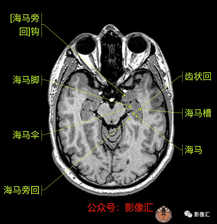 影像PPT - 脑边缘叶MR解剖标记-19