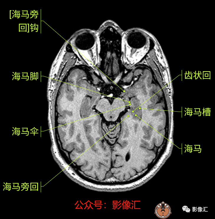 影像PPT - 脑边缘叶MR解剖标记-20