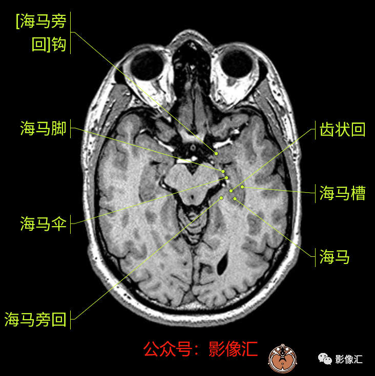 影像PPT - 脑边缘叶MR解剖标记-22