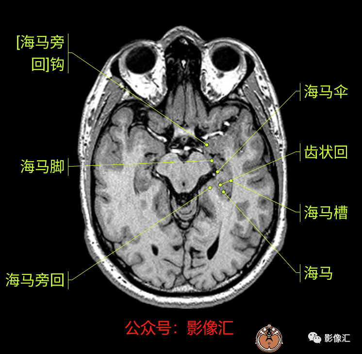 影像PPT - 脑边缘叶MR解剖标记-23