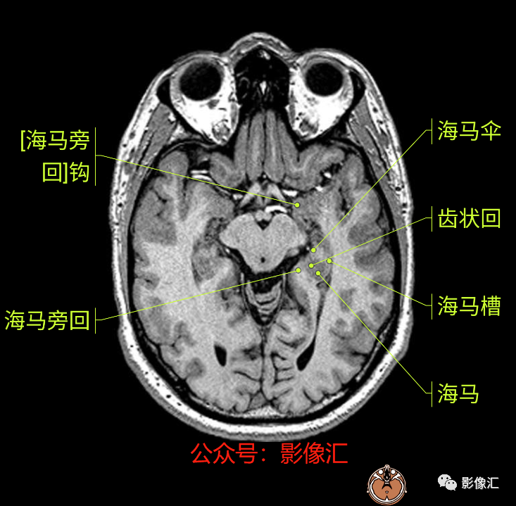 影像PPT - 脑边缘叶MR解剖标记-24