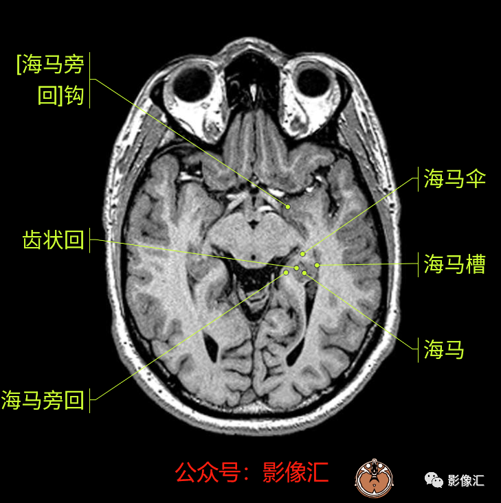 影像PPT - 脑边缘叶MR解剖标记-25