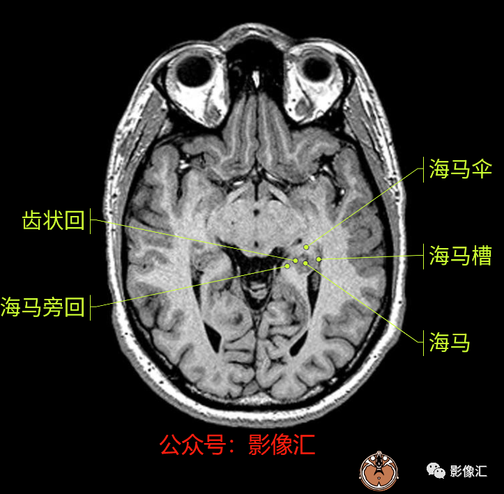 影像PPT - 脑边缘叶MR解剖标记-26