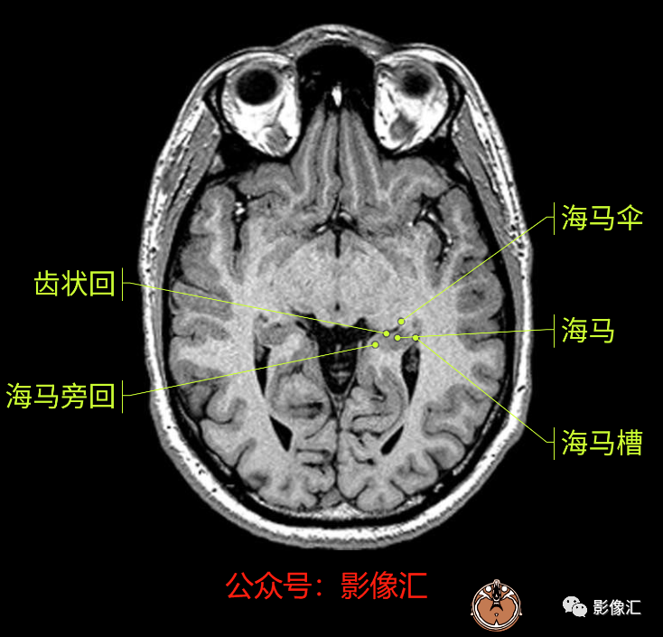 影像PPT - 脑边缘叶MR解剖标记-27