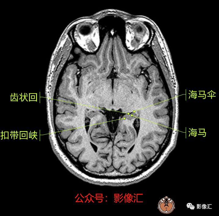 影像PPT - 脑边缘叶MR解剖标记-28
