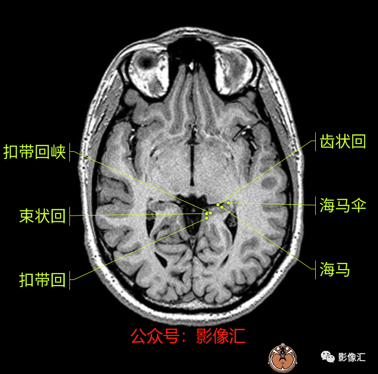 影像PPT - 脑边缘叶MR解剖标记-29