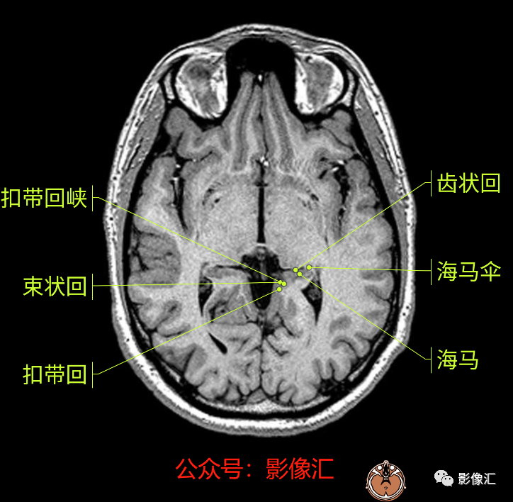 影像PPT - 脑边缘叶MR解剖标记-30