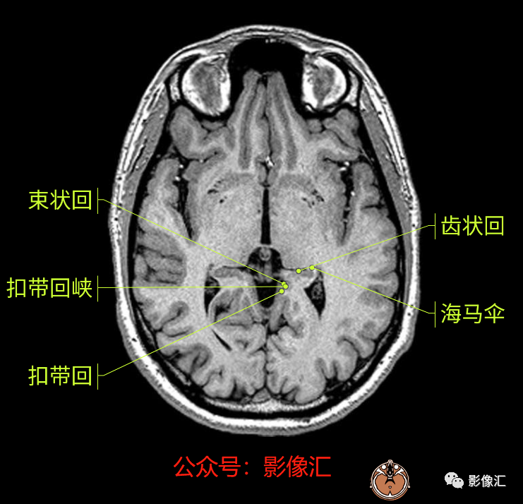 影像PPT - 脑边缘叶MR解剖标记-31