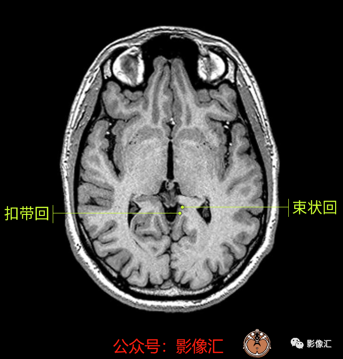 影像PPT - 脑边缘叶MR解剖标记-32