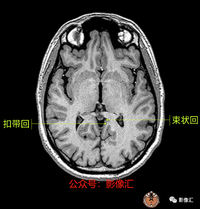 影像PPT - 脑边缘叶MR解剖标记-33