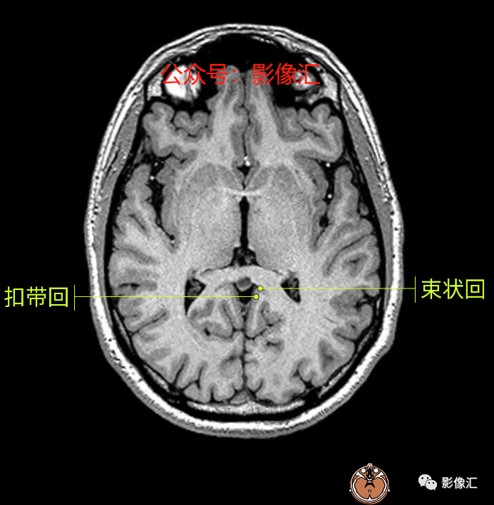 影像PPT - 脑边缘叶MR解剖标记-34