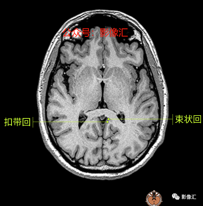 影像PPT - 脑边缘叶MR解剖标记-35